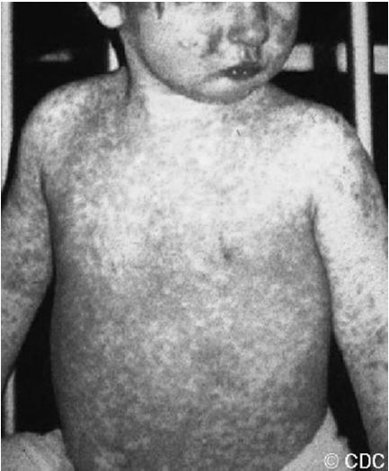 Measles Also known as Rubeola (NOT Rubella) Highly contagious Attack rate in susceptible household contacts: 75% 90% Transmitted via respiratory droplets and aerosol Spread