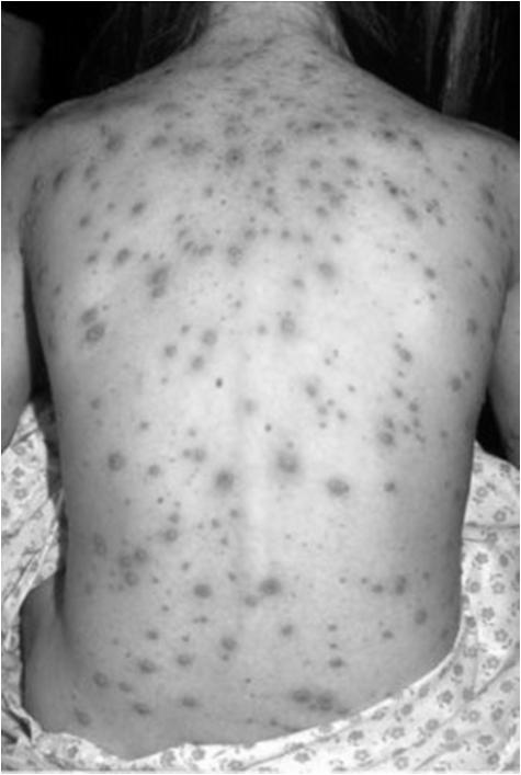 Chickenpox Caused by the Varicella