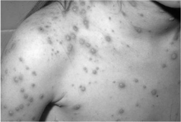chickenpox and shingles Primary