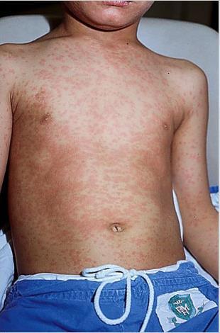 early in the course of measles http://www.cdc.gov/measles/hcp/index.