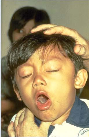 Pertussis: Sounds of the Cough One place