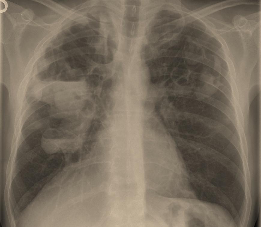 (A) Observe a solitary lung nodule in the right