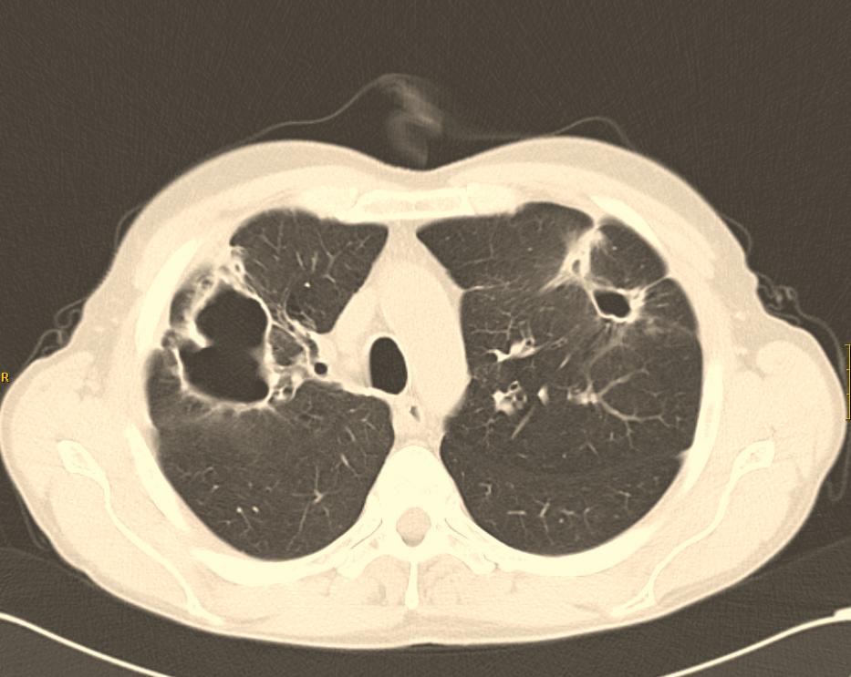 ressection). (B) Multiple cavitated lung nodules.
