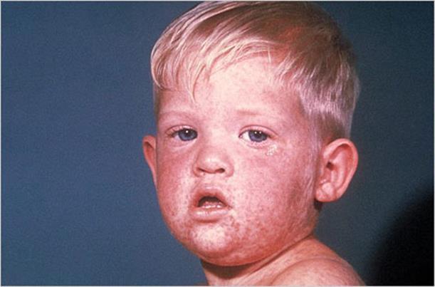 Measles, cont.