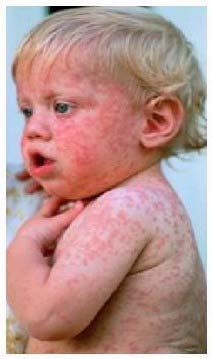 Measles Viral illness Highly infectious Human reservoir only Respiratory transmission