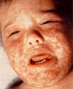 Measles complications Reported in ~30% cases Diarrhoea 8% Otitis media 7% Pneumonia 6%