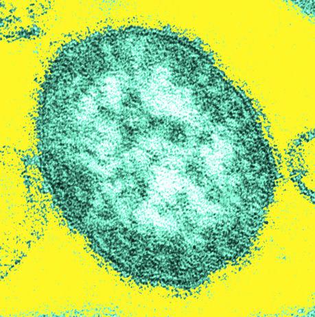 Measles virus RNA virus Family: Paramyxoviridae.