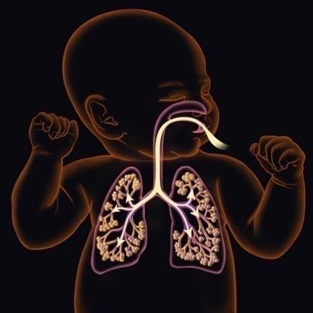 An Inhaled Vasodilator Inhalation of NO offers selective activity The only FDA-approved drug that selectively dilates the pulmonary vasculature 1 Targeted delivery to the pulmonary bed 1 Inhalation