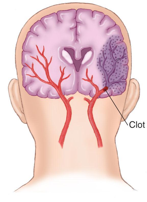 vessels and may obstruct blood flow.