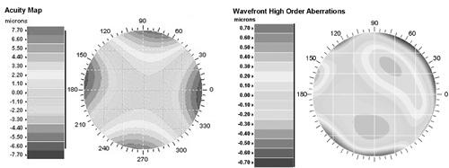 focusing errors. In Figure 3 is a map of all wavefront errors and on the right is a map showing just the complex errors. The combination of simple and complex wavefront errors in any eye is unique.