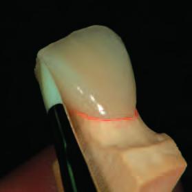 layering of already grinded composite surfaces, e.g. after the form correction of the dentine core.