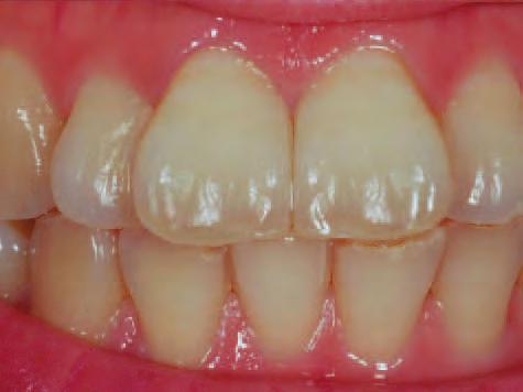 dentine, body, translucent and incisal can
