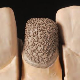 strength for attachment cement, particularly with metal-free restorations.