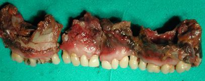 Dental condition of the 78 examined victims in 42 cases there was no loss of dental data in relation to the accident (all belonging to the category of blunt trauma ) 21 of them