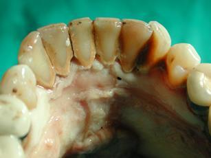 third molars,