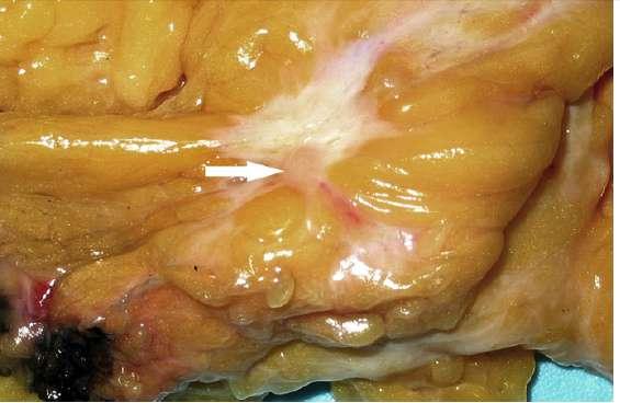 Tumor bed Grossly: fibrous