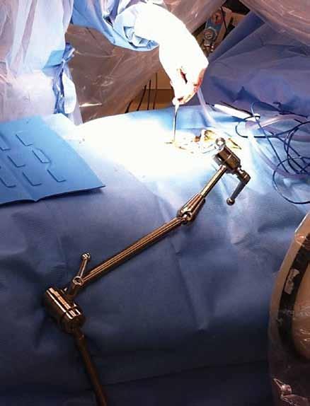 Some surgeons prefer to use an operating microscope instead of loupes. The standard electrosurgery and bipolar machines also are needed.
