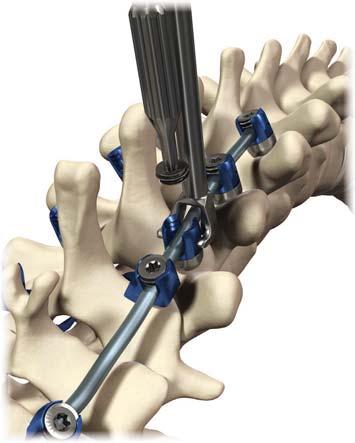 Virage OCT Spinal Fixation System Surgical Technique 13 Set Screw Insertion: Closure Top Placement Rod Reduction: Rod Rocker Kerrison Rod Reducer Fig. 24 Fig. 25 Fig.