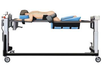 Step 1 Place the patient on a radiolucent operating table in the prone position with the head and neck held securely in proper alignment. Drape the patient for posterior spinal fusion. (Fig.