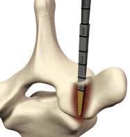 K-wires or pedicle markers may be placed into the pedicle throughout the preparation, confirming position on