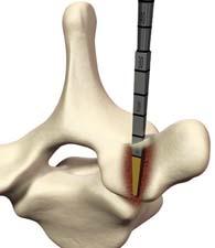 Step 4, Option A Insert the pedicle Probe in the previously prepared entry point while maintaining the