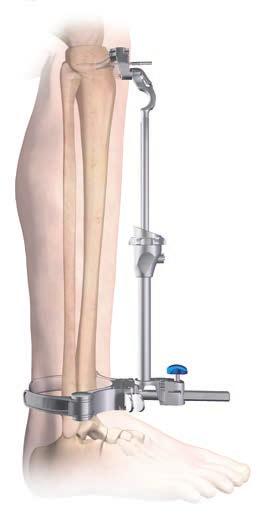 Slope The tibial jig uprod and ankle clamp are designed to prevent an adverse anterior slope.
