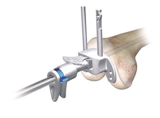 The valgus angle (left or right - 0º to 9º) on the femoral alignment guide is set by compressing the two triggers and locked in place by rotating the blue locking lever clockwise (Figure 23 and
