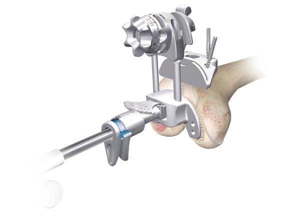 Slide the femoral resection guide upwards over the legs until the block connector disengages the cutting block and in one motion remove the femoral alignment guide by pulling the instruments distally
