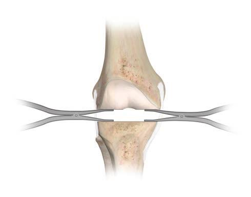 Extension Gap Assessment and Balancing Place the knee in full extension and apply laminar spreaders medially and laterally.