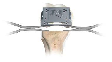 guide (Figure 41). The femoral positioner should mirror the extension gap previously evaluated with the spacer block.