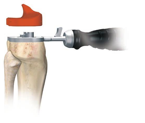 Select the tibial insert trial that matches the chosen femoral size and style, curved or stabilised, and insert it onto the M.B.T. tray trial (Figure 54).