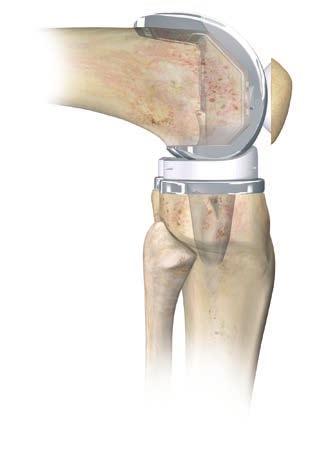 The patellar implant may now be cemented. Thoroughly cleanse the cut surface with pulsatile lavage. Apply cement to the surface and insert the component.
