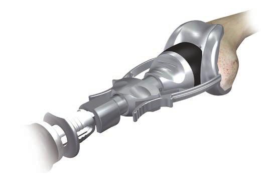 Appendix A: Fixed Bearing Modular Tibial Preparation Femoral Trial Attach the slaphammer or universal handle to the femoral inserter / extractor.
