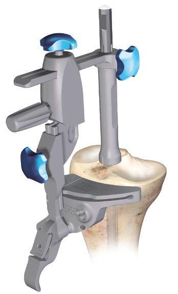 Slide the appropriate fixed or adjustable stylus in the HP tibial cutting block slot. When measuring from the less damaged side of the tibia plateau set the stylus to 8 mm or 10 mm.