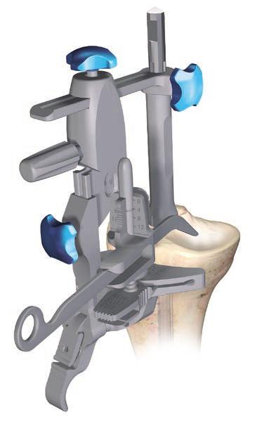 Slide the total construct as close as possible towards the proximal tibia and lock this position. Adjust the correct degree of slope by rotating the slope adjustment screw.
