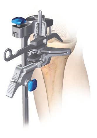 Appendix D: Spiked Uprod Non-slotted stylus foot Height Loosen the proximal / distal sliding knob, insert the adjustable tibial stylus into the cutting block, and adjust to the correct level of