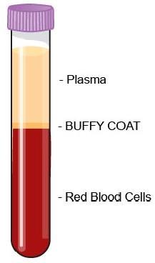 Collection of Blood from Patients 1 tube of blood typically contains: o ~10ml blood o ~4-5ml plasma 1 to 4 ml plasma is sufficient for