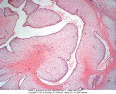Phyllodes tumor Biphasic, being composed of neoplastic stromal cells and