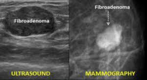 The most important thing is when these conditions produce a mass and abnormal mammogram you should investigate them more to confirm that they are benign.
