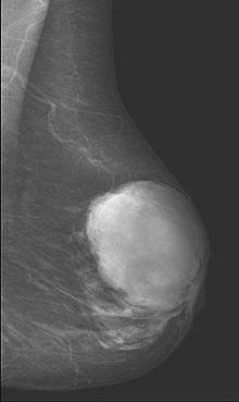 This is a mammogram of phyllodes tumor, it is well