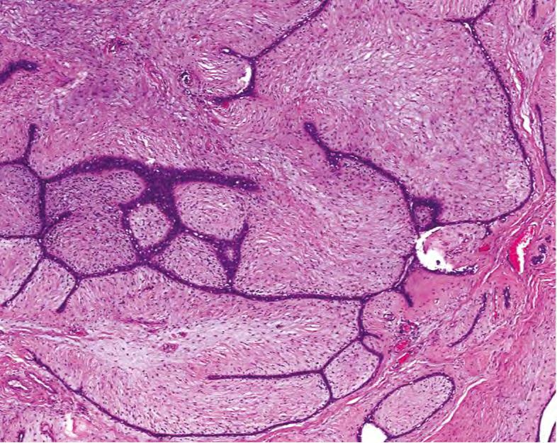 Phyllodes Tumor Heterogeneous histology Elongated epitheliallined clefts is a