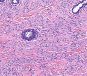 Pseudoangiomatous Stromal Hyperplasia No necrosis or fat