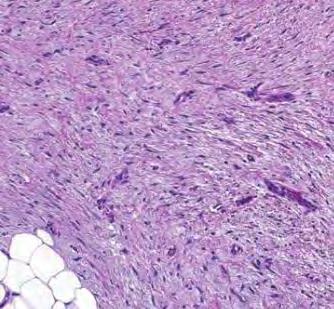 Fibromatosis Locally infiltrative lesion Fibroblasts/myofibroblasts Pectoral