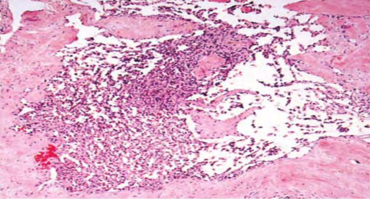 Angiosarcoma Histologic Features Grade Low Intermediate High Breast Parenchyma