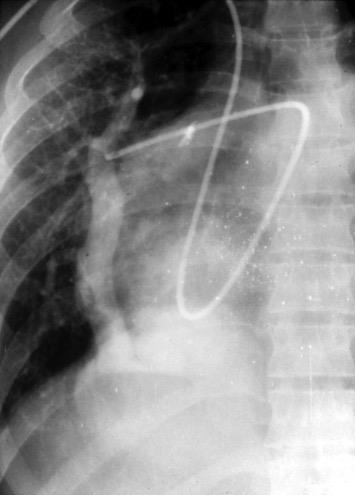 b. d. Scimitar syndrome associated with pulmonary