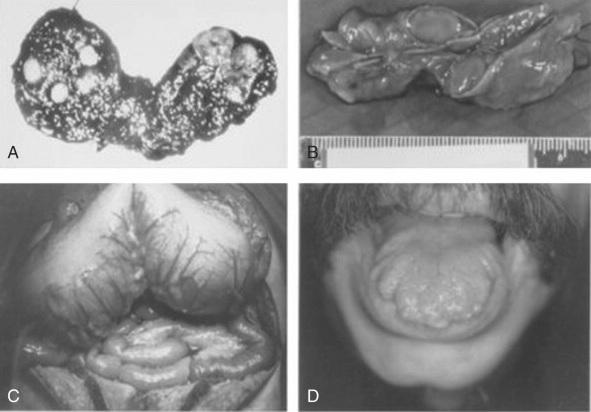 Features of Patients with Hereditary MTC A Bisected thyroid gland from a patient with MEN 2A showing multicentric, bilateral foci of MTC B Adrenalectomy specimen from