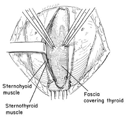 Thyroid Gland Exposure www.downstatesurgery.