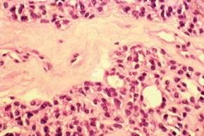 V Histologically, MTC can be identified by calcitonin