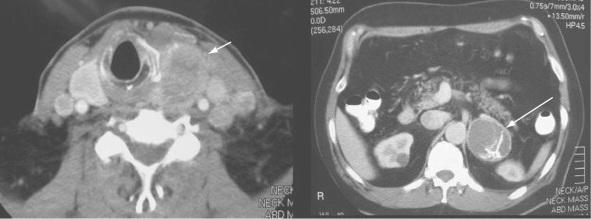 A, CT scan of the neck in a patient with MEN 2A and untreated medullary thyroid carcinoma (arrow) with