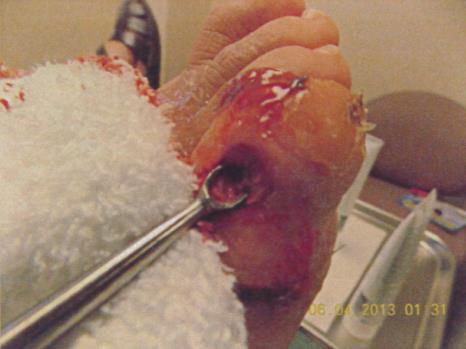 Forshortening of the toe as a result of the piecemeal debridement and removal of the fifth proximal phalanx bone six days before.